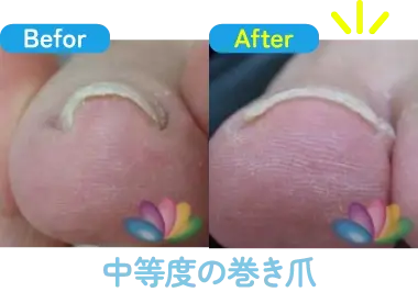 中等度の巻き爪の治療前と治療後の比較