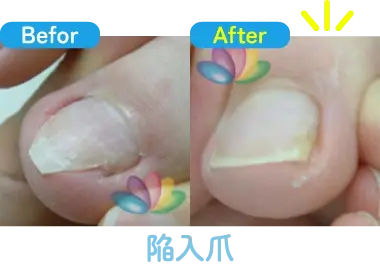 陥入爪の治療前と治療後の比較